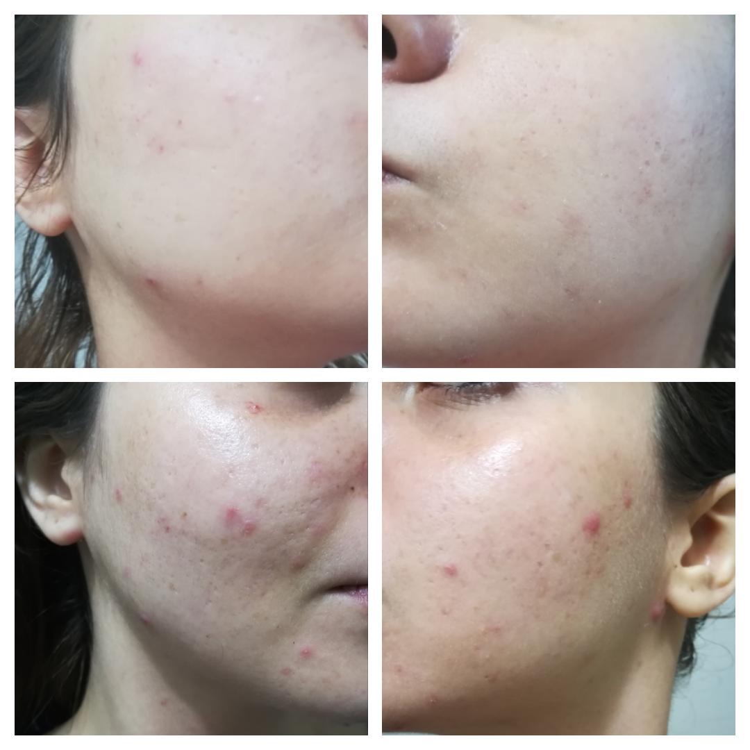 ANTI ACNE BUNDLE (REMOVE ACNE WIITHIN 7 DAYS )