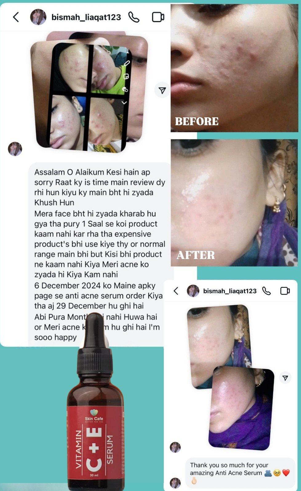 ANTI ACNE  SERUM REMOVE ACNE IN 3 DAYS !