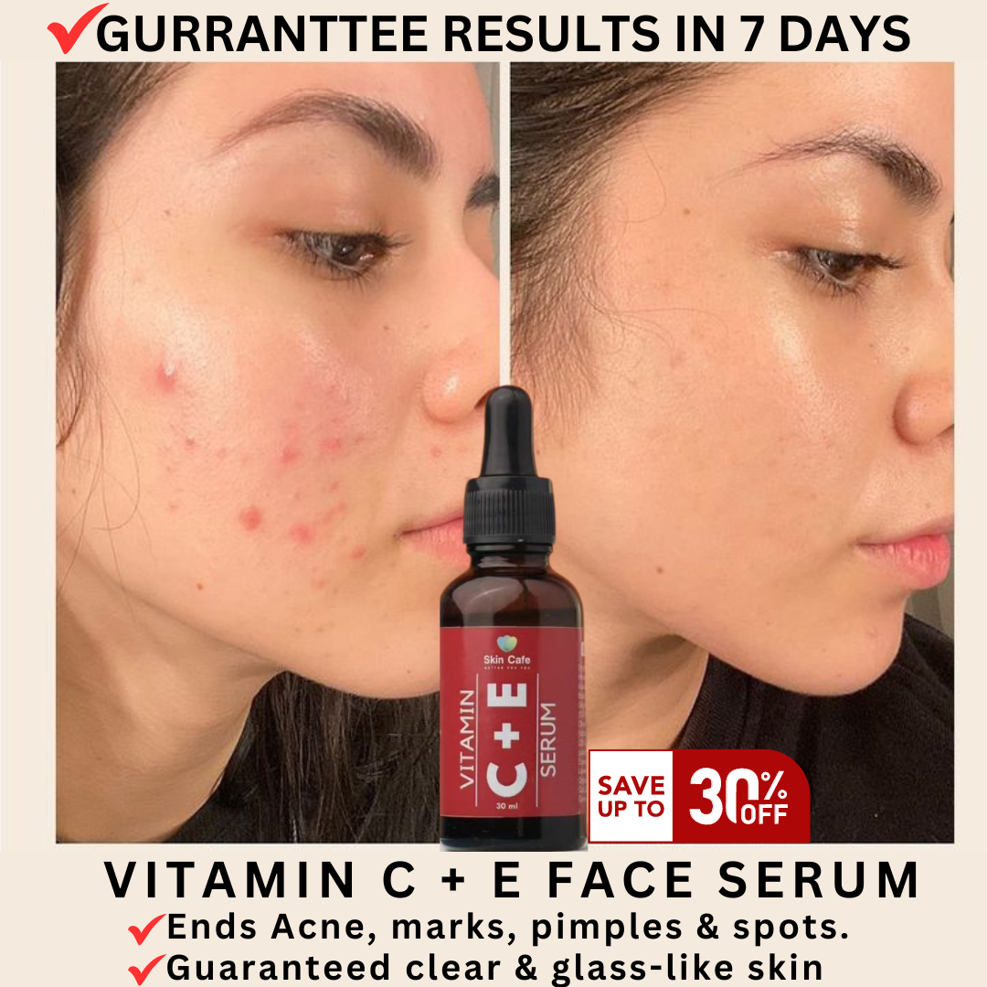ANTI ACNE BUNDLE (REMOVE ACNE WIITHIN 7 DAYS )