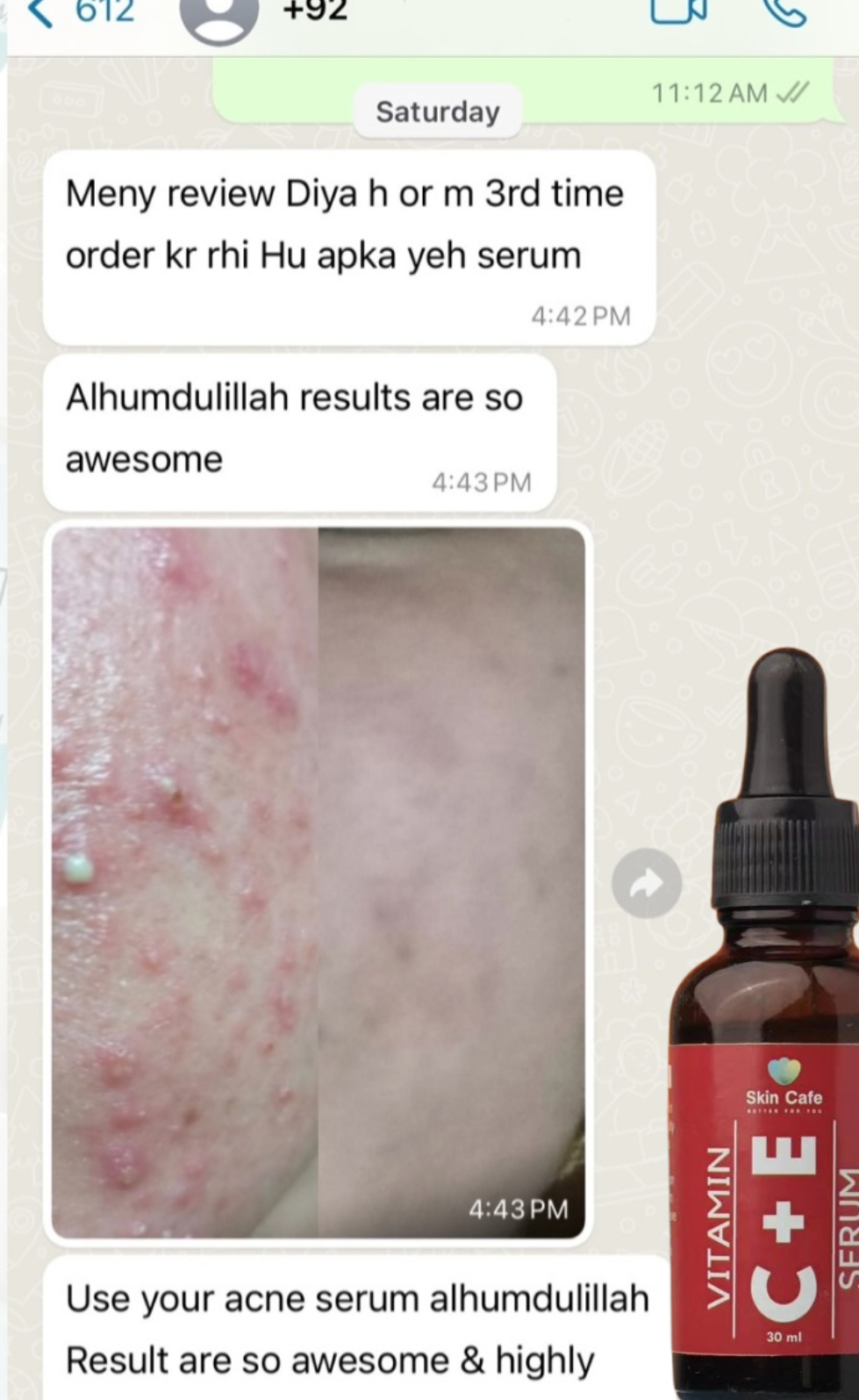 ANTI ACNE  SERUM REMOVE ACNE IN 3 DAYS !