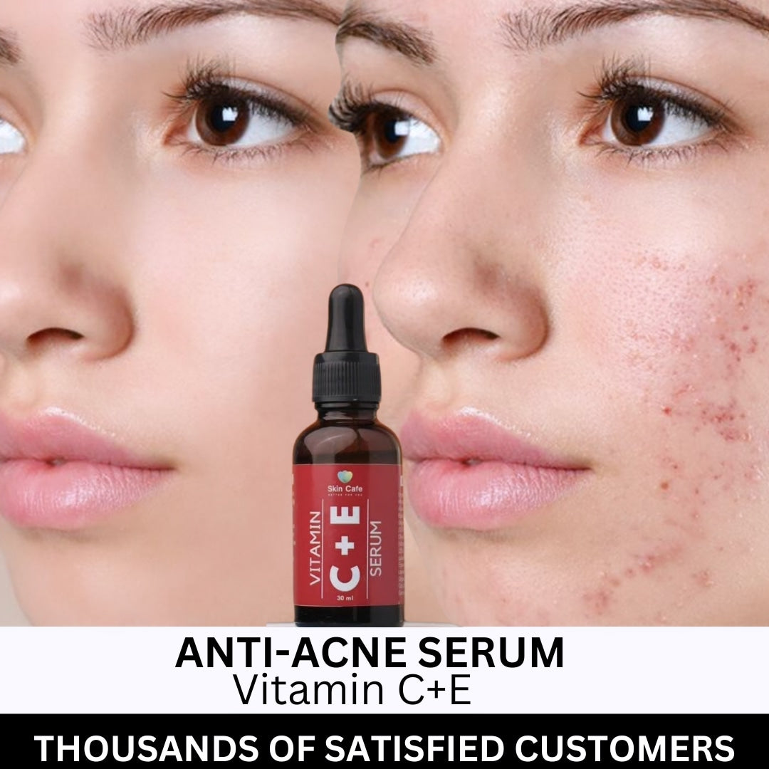 ANTI ACNE  SERUM REMOVE ACNE IN 3 DAYS !