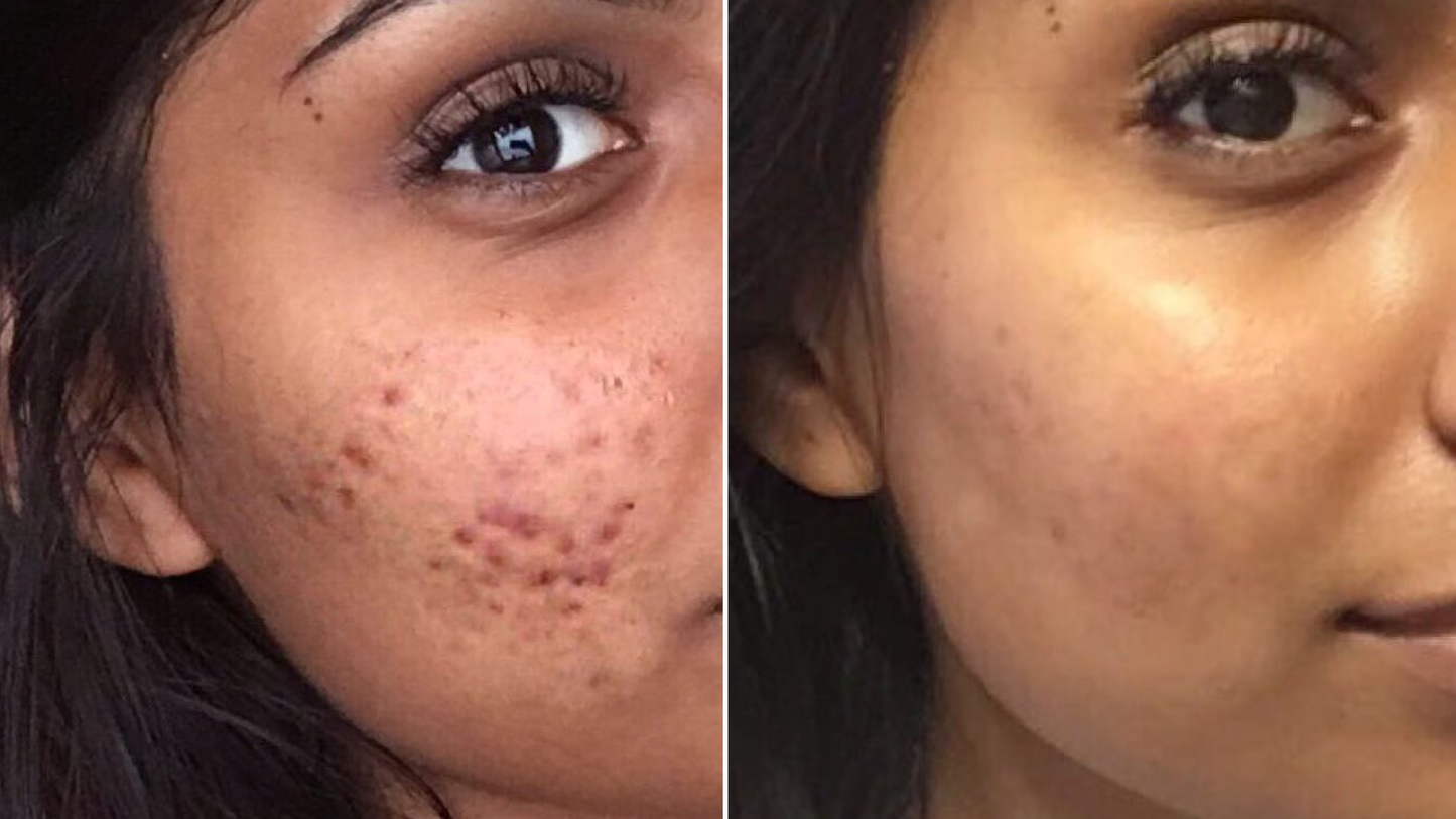 ANTI ACNE  SERUM REMOVE ACNE IN 3 DAYS !