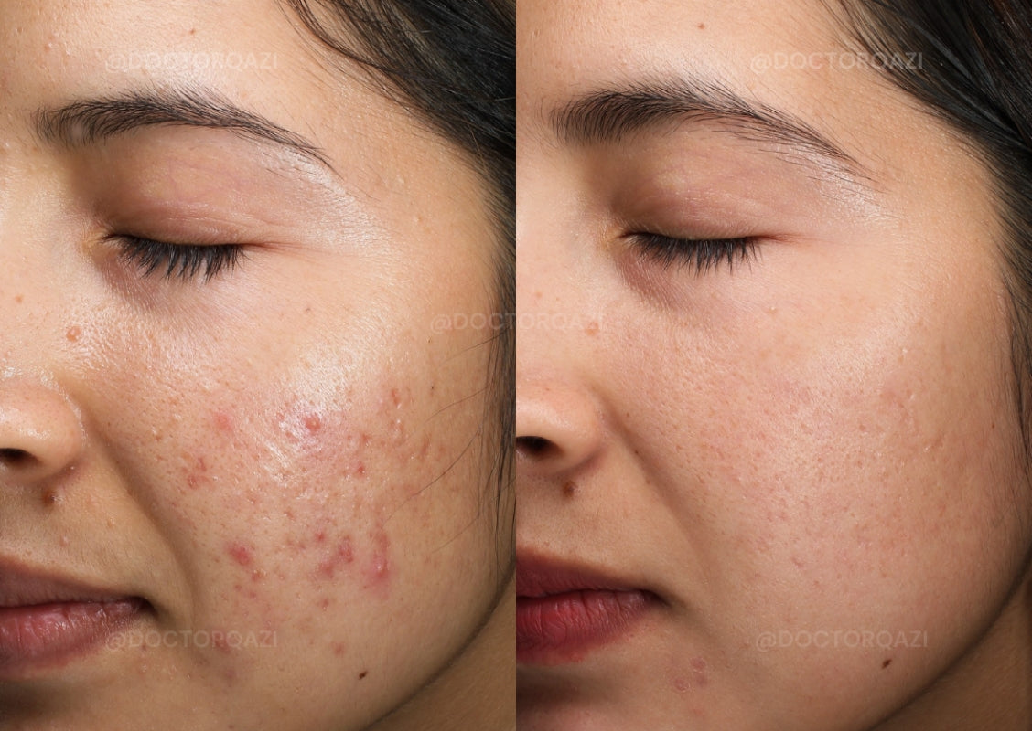 ANTI ACNE BUNDLE (REMOVE ACNE WIITHIN 7 DAYS )