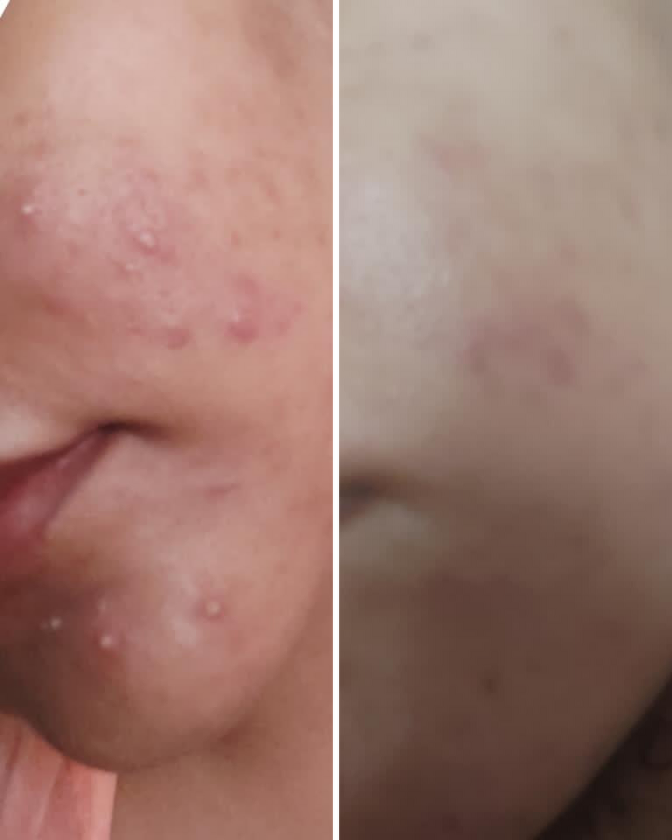 ANTI ACNE  SERUM REMOVE ACNE IN 3 DAYS !