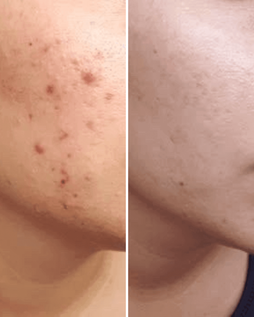 ANTI ACNE  SERUM REMOVE ACNE IN 3 DAYS !